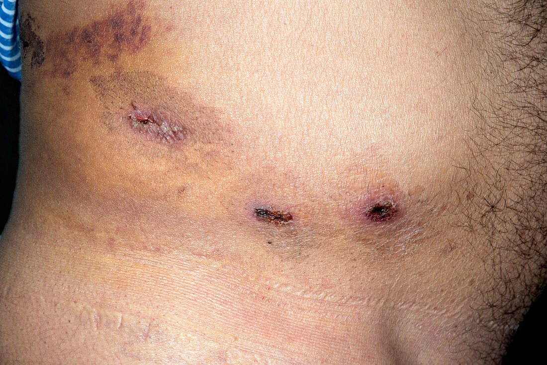 Infected wounds after laparoscopy