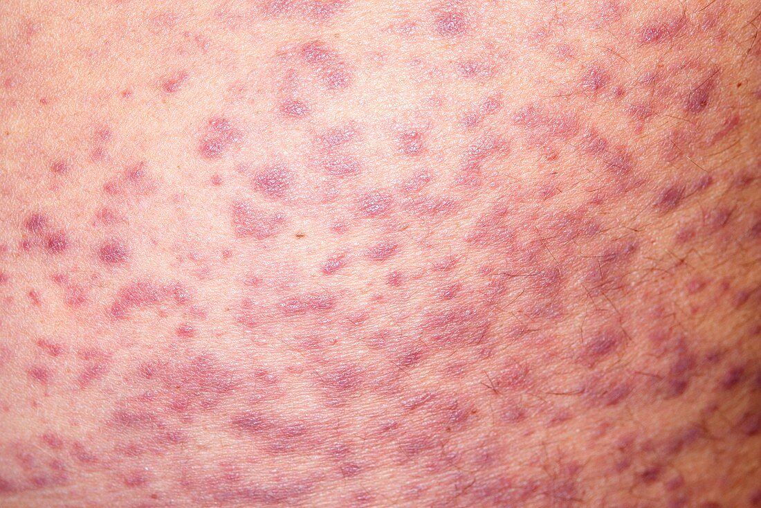 Rash caused by allergy to Trimethoprim