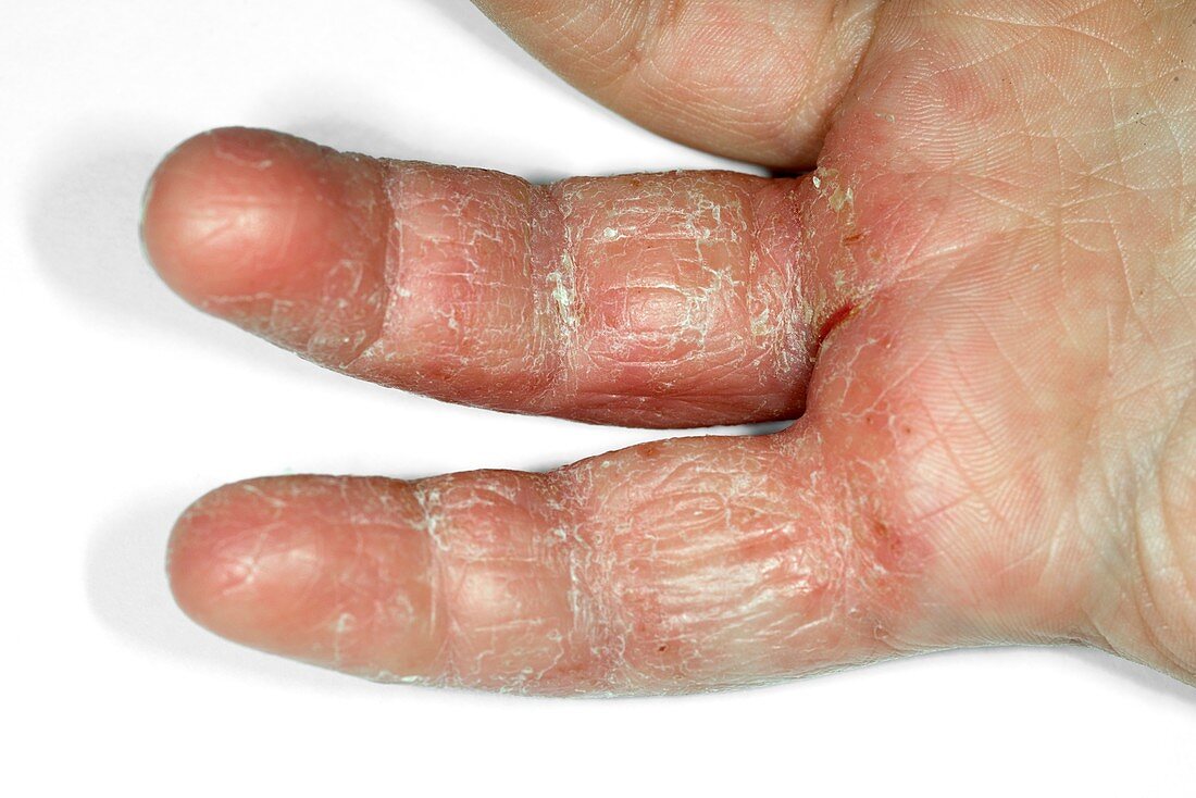 Eczema on fingers of a young boy
