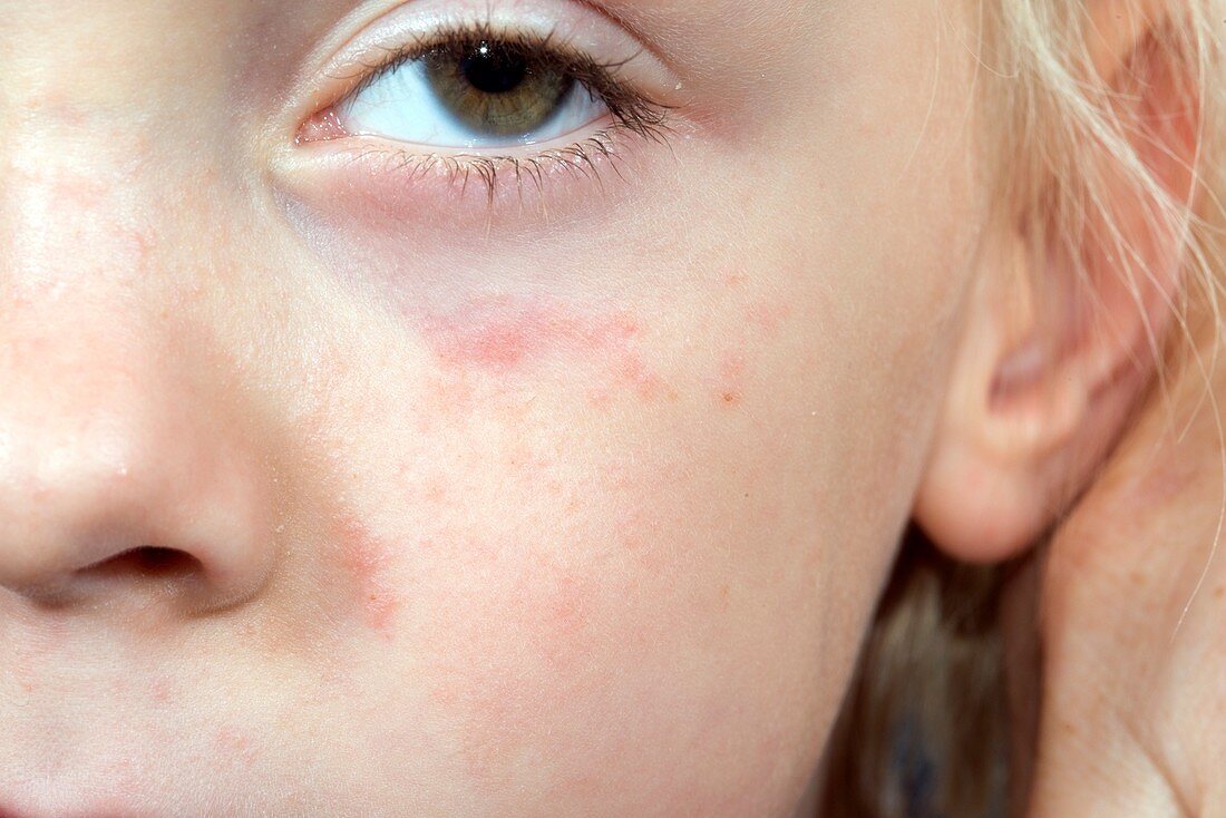 Viral urticaria on a girl's face