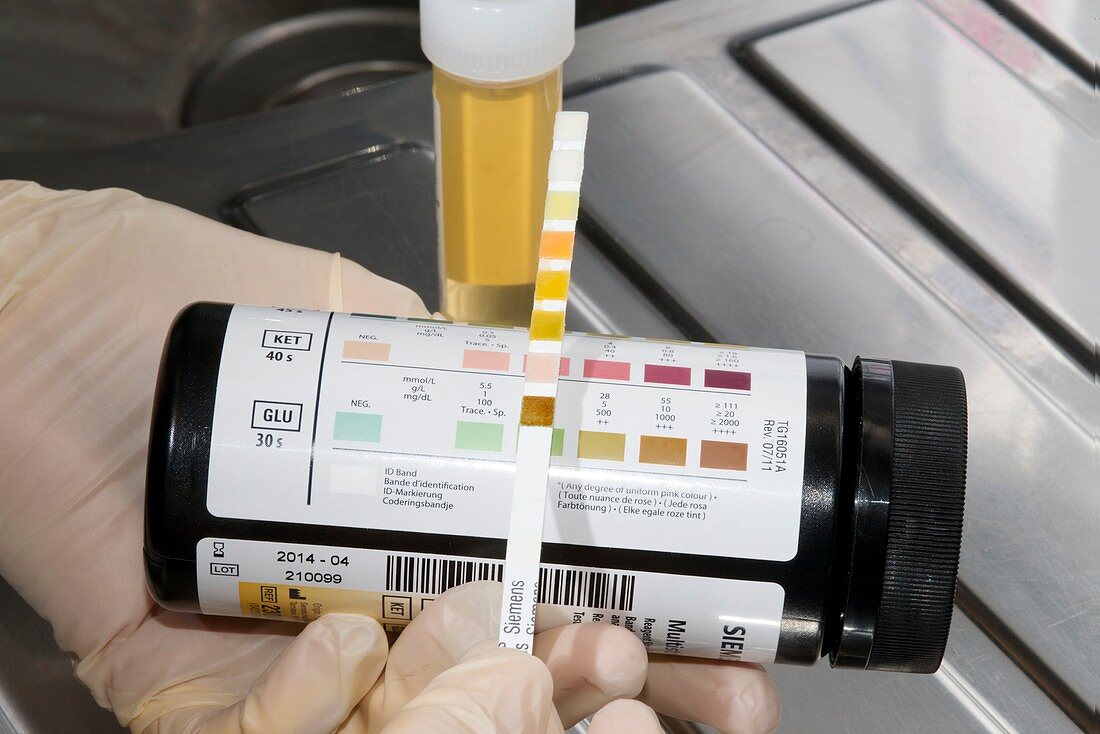 Glucose in urine in dipstick test