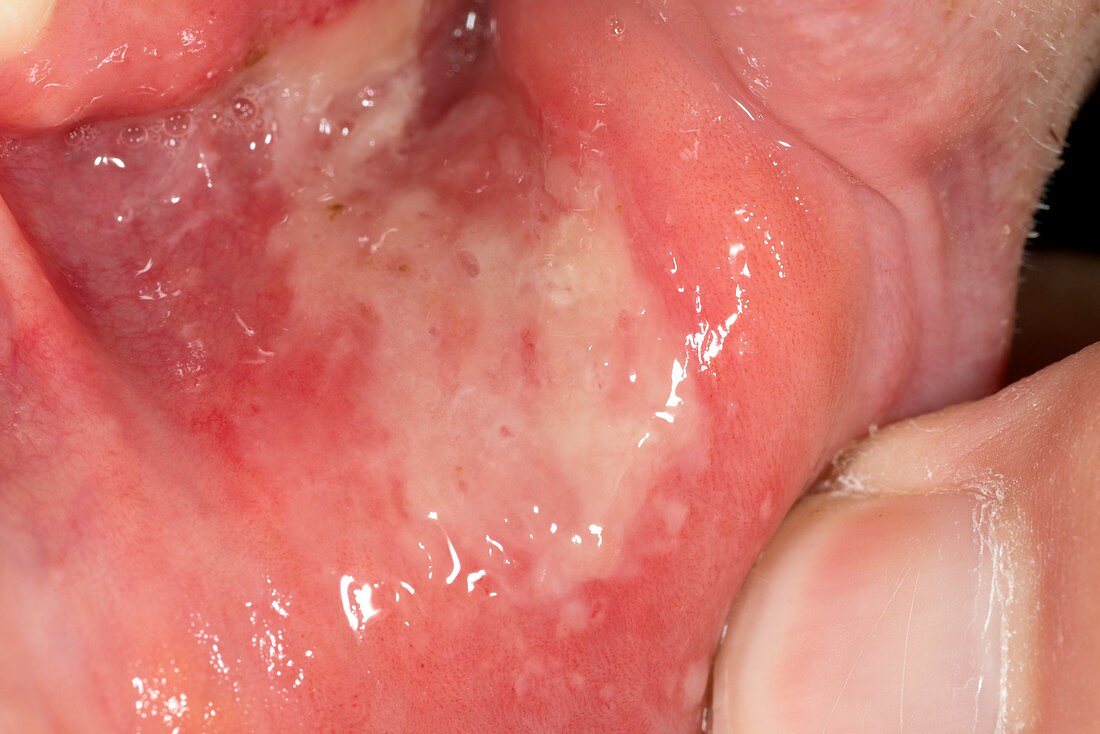 Extensive mouth ulcer