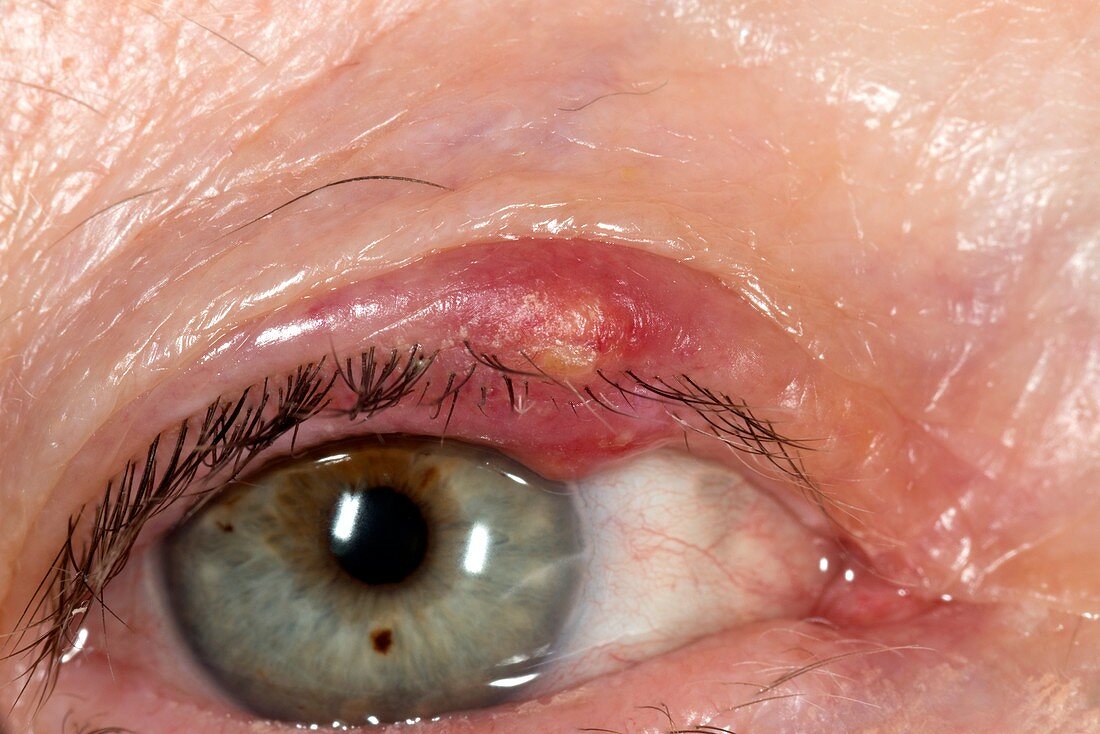 Infected eyelid cyst