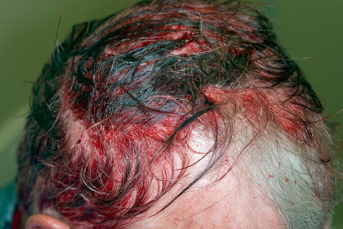Head injury from a scaffolding pole