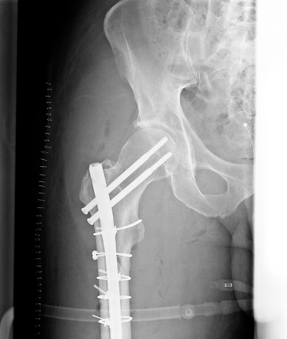 X-ray of pinned fractured femur