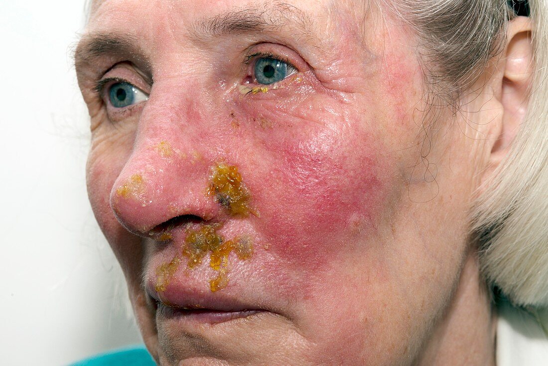 Shingles rash on the face