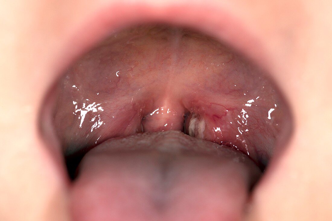 Viral throat infection