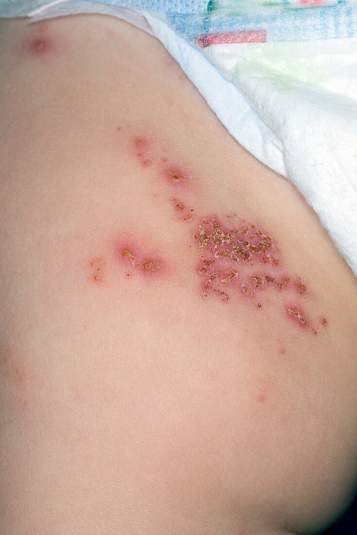 Shingles in a 7 month old baby
