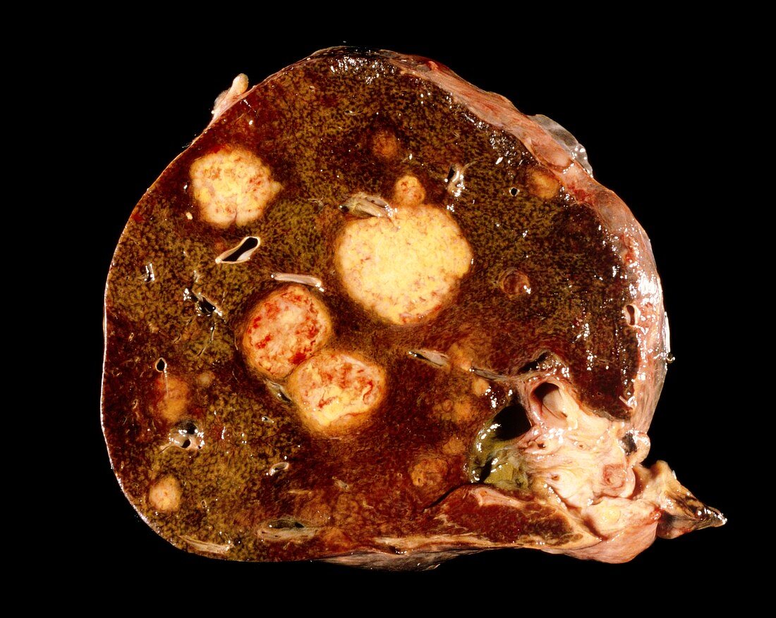 Secondary cancers of the liver