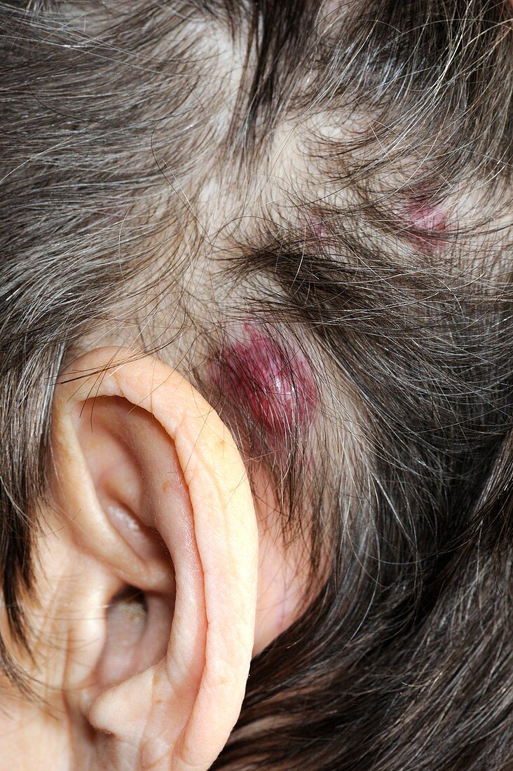 Cancerous nodule on the head