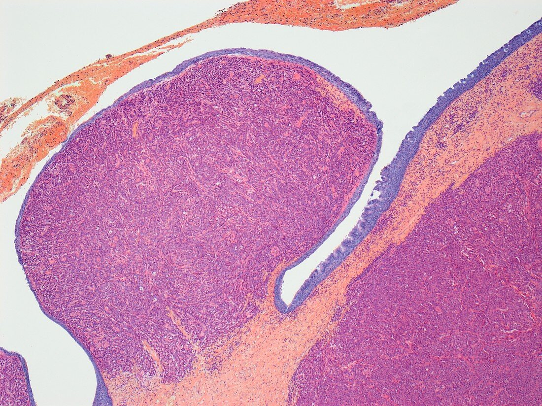 Plasmacytoma,light micrograph