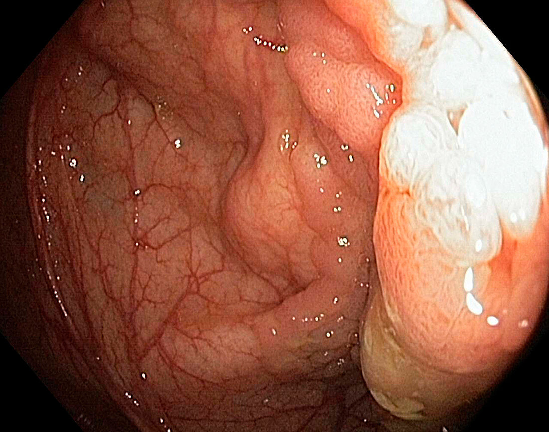 Colon adenoma,endoscope view