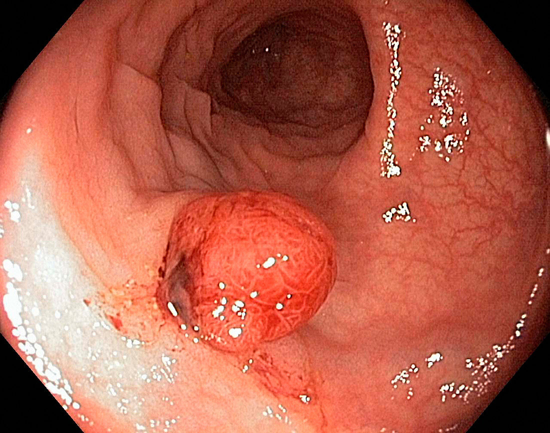 Colonic polyp,endoscope view