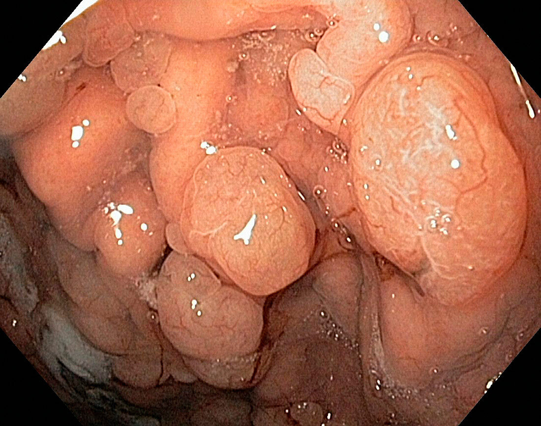 Stomach polyps,endoscope view
