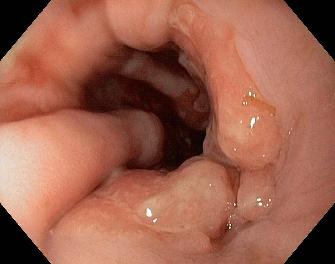 Oesophagus cancer,endoscope view