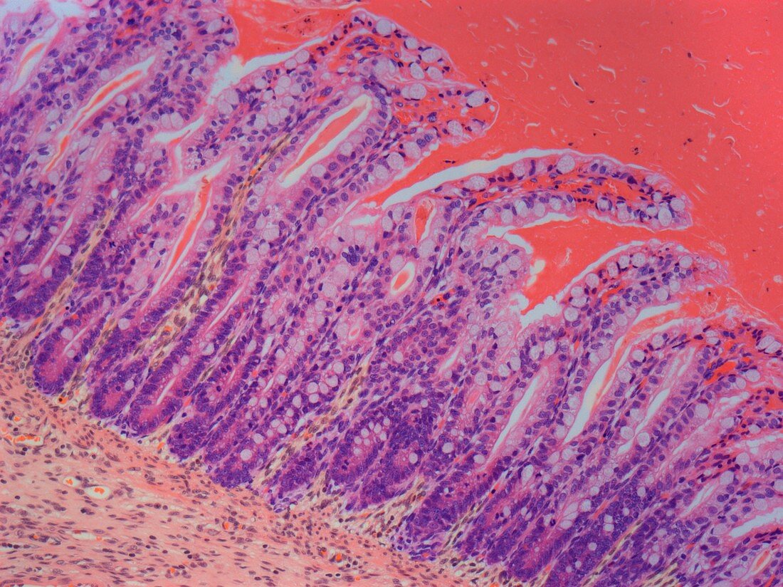 Cystic fibrosis,light micrograph