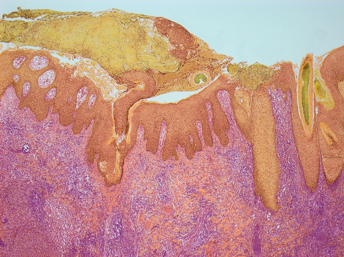 Ringworm,light micrograph