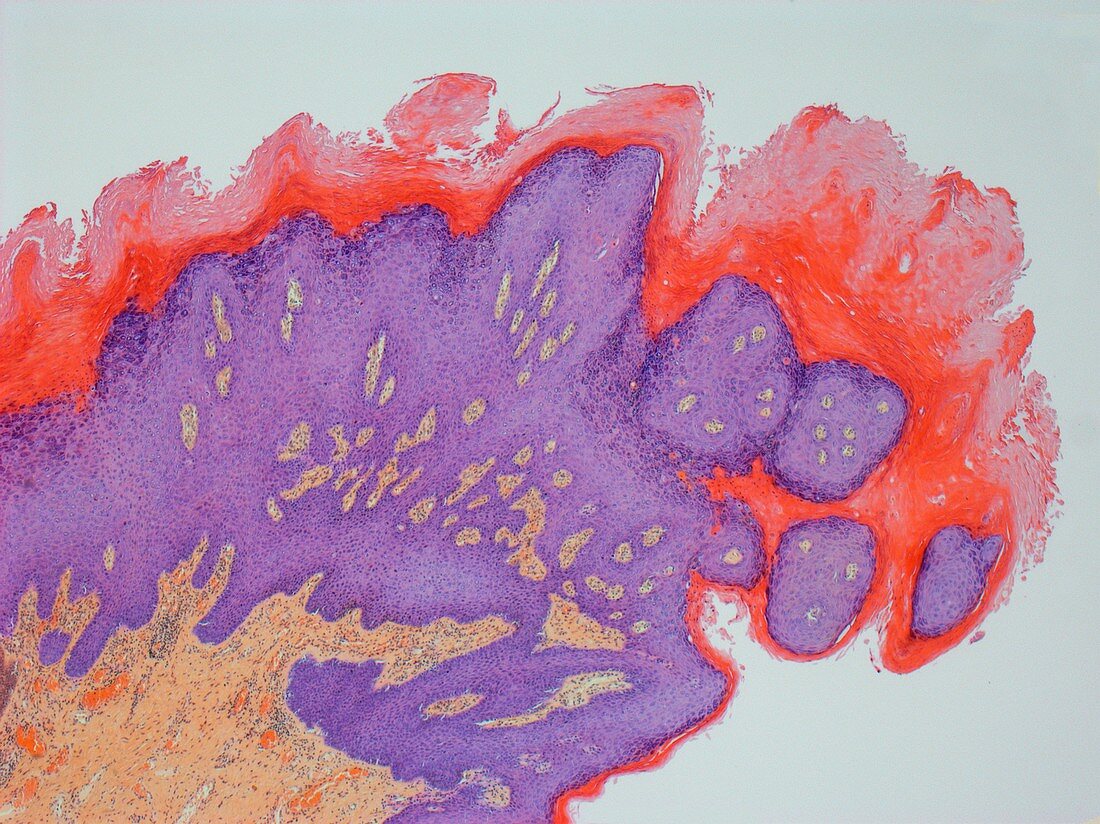 Vaginal lesion in HIV,light micrograph