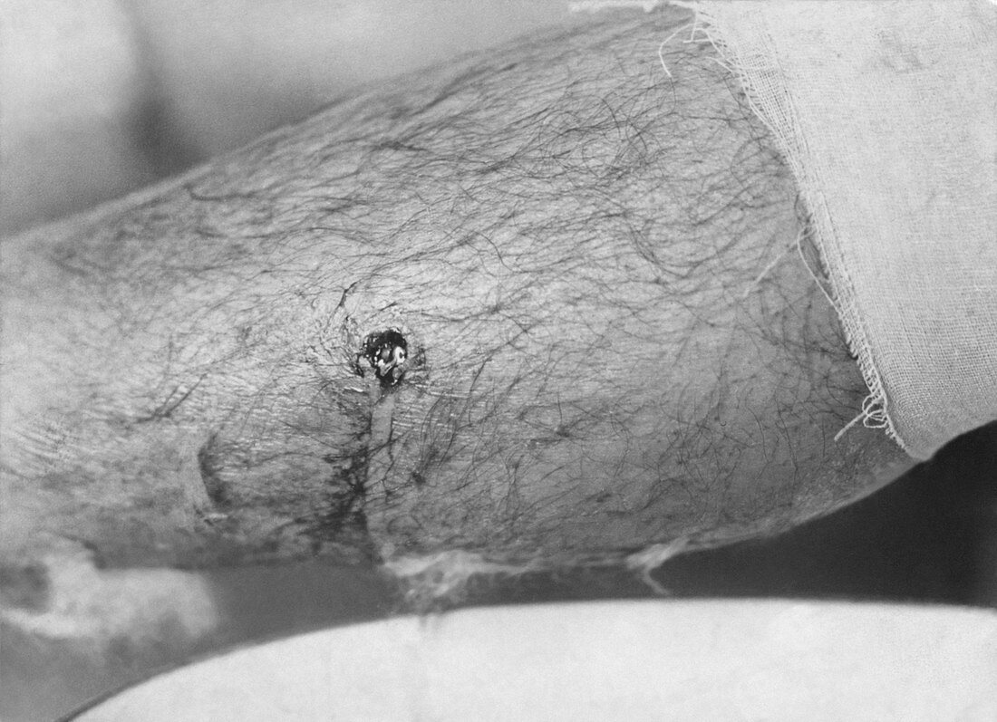Bullet entry wound