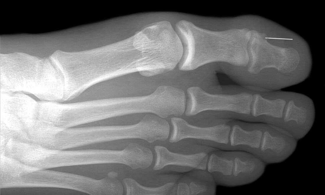 Needle stuck in toe,X-ray