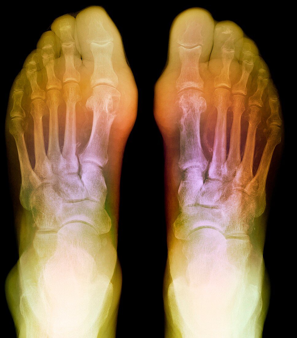 Gout,X-ray