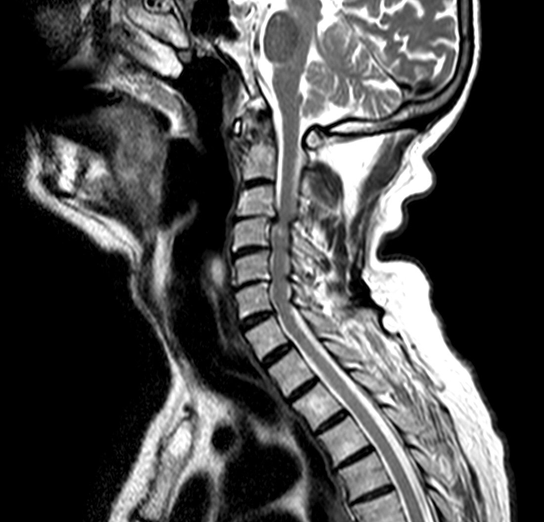 Compressed spinal cord,MRI scan