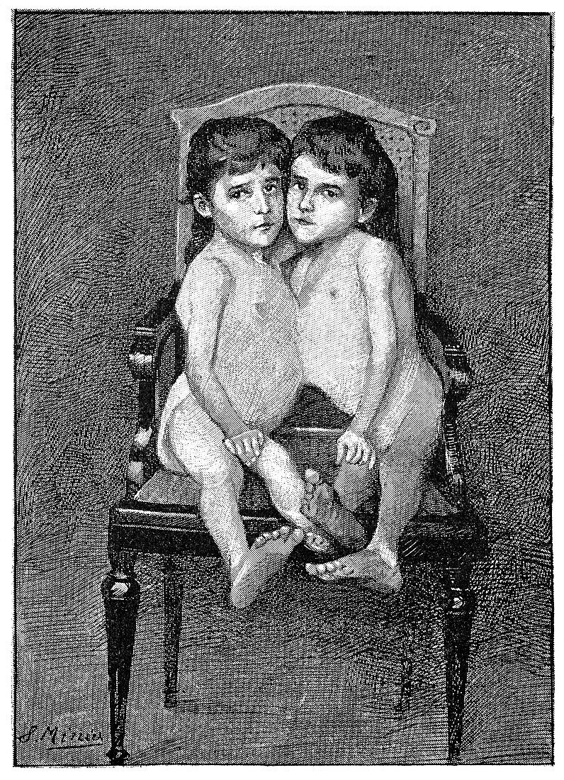 Conjoined twins,early 20th century