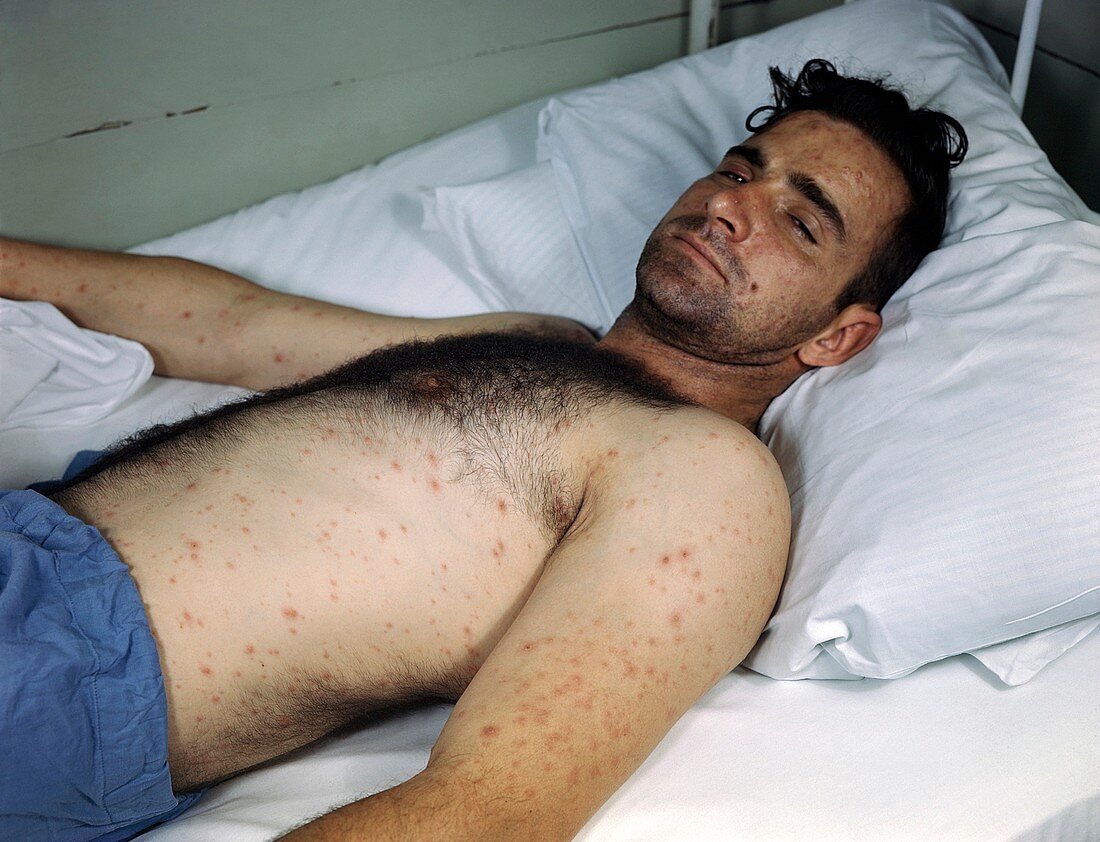 Smallpox infection