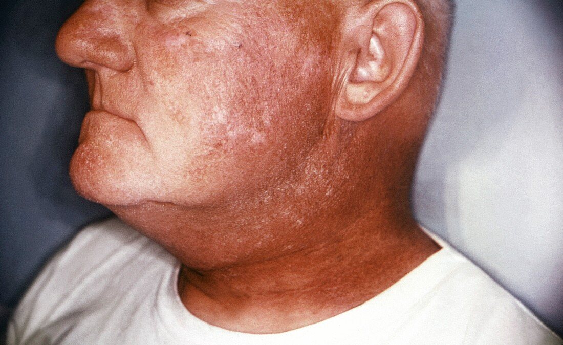 Radiation dermatitis of the face