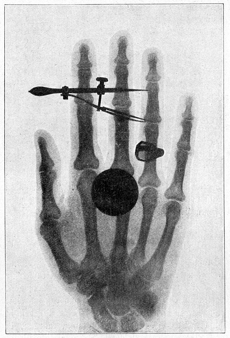 Female hand,19th Century X-ray