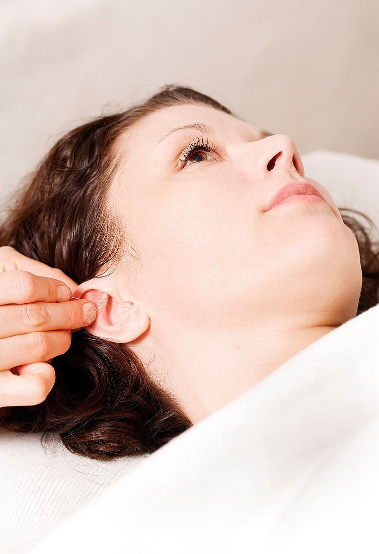 NADA acupuncture treatment