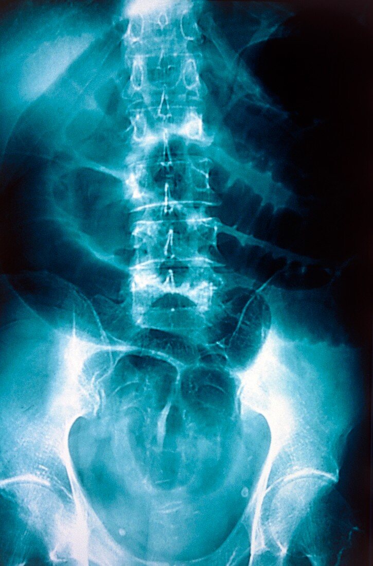 Bowel obstruction,X-ray