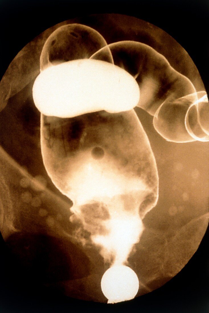 Rectal tumour,barium X-ray