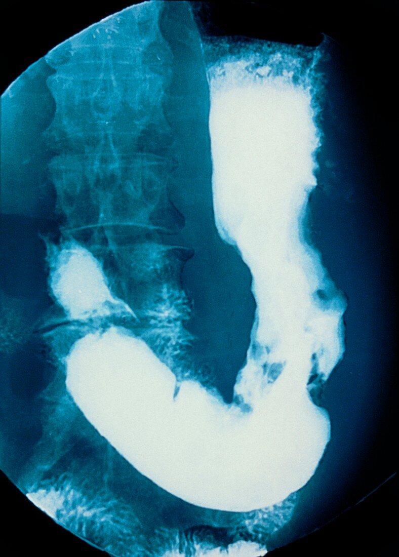 Stomach cancer,X-ray