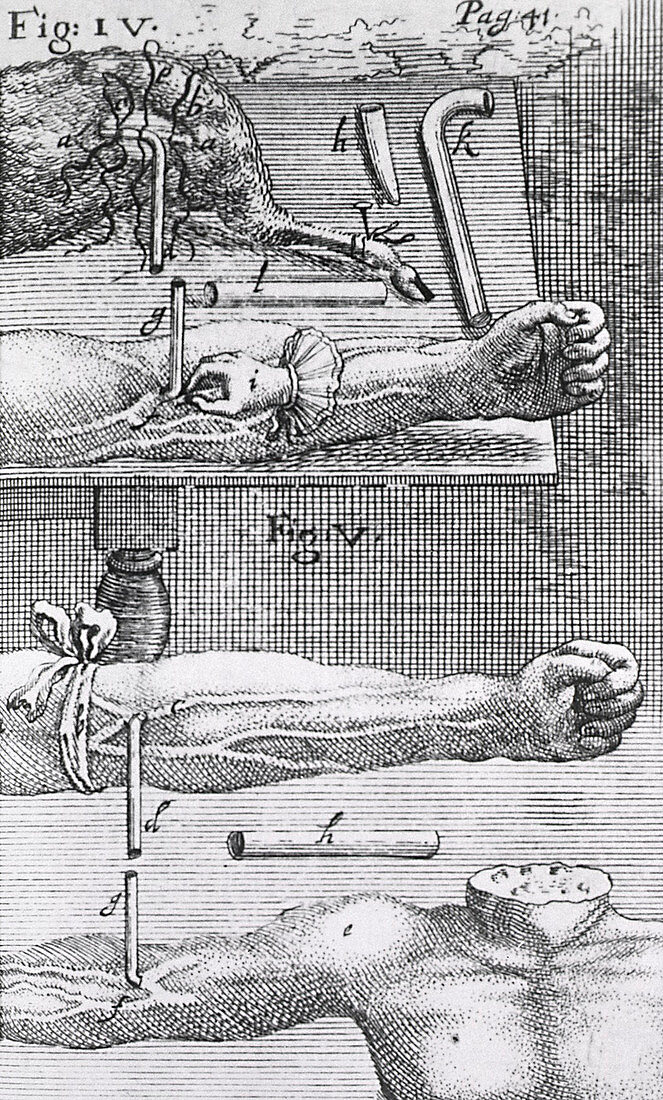 Animal-human blood transfusion,1660s
