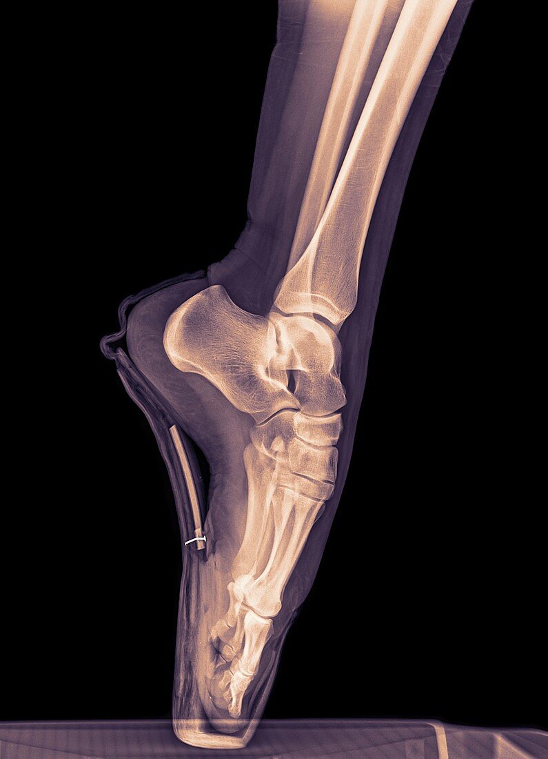 Ballet Dancer x-ray