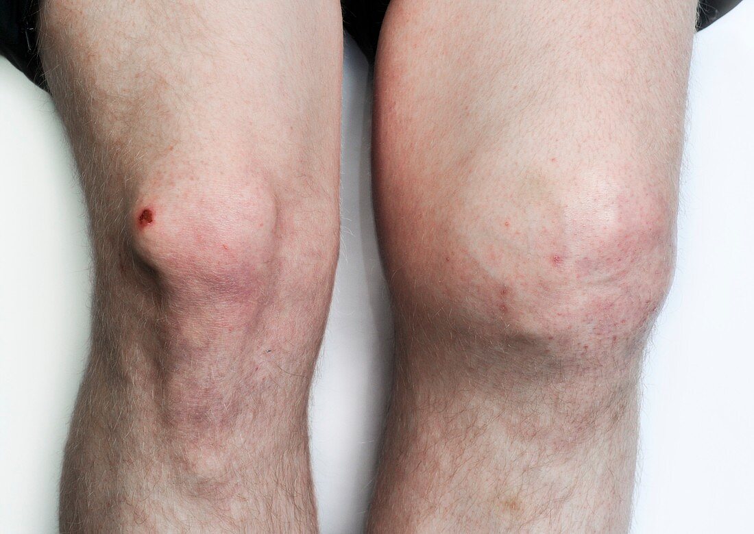 Osteoarthritis of the left knee