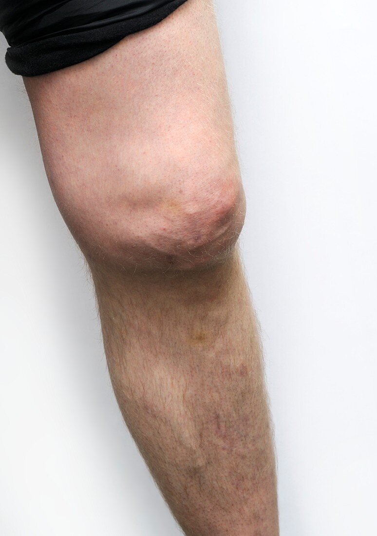 Osteoarthritis of the left knee