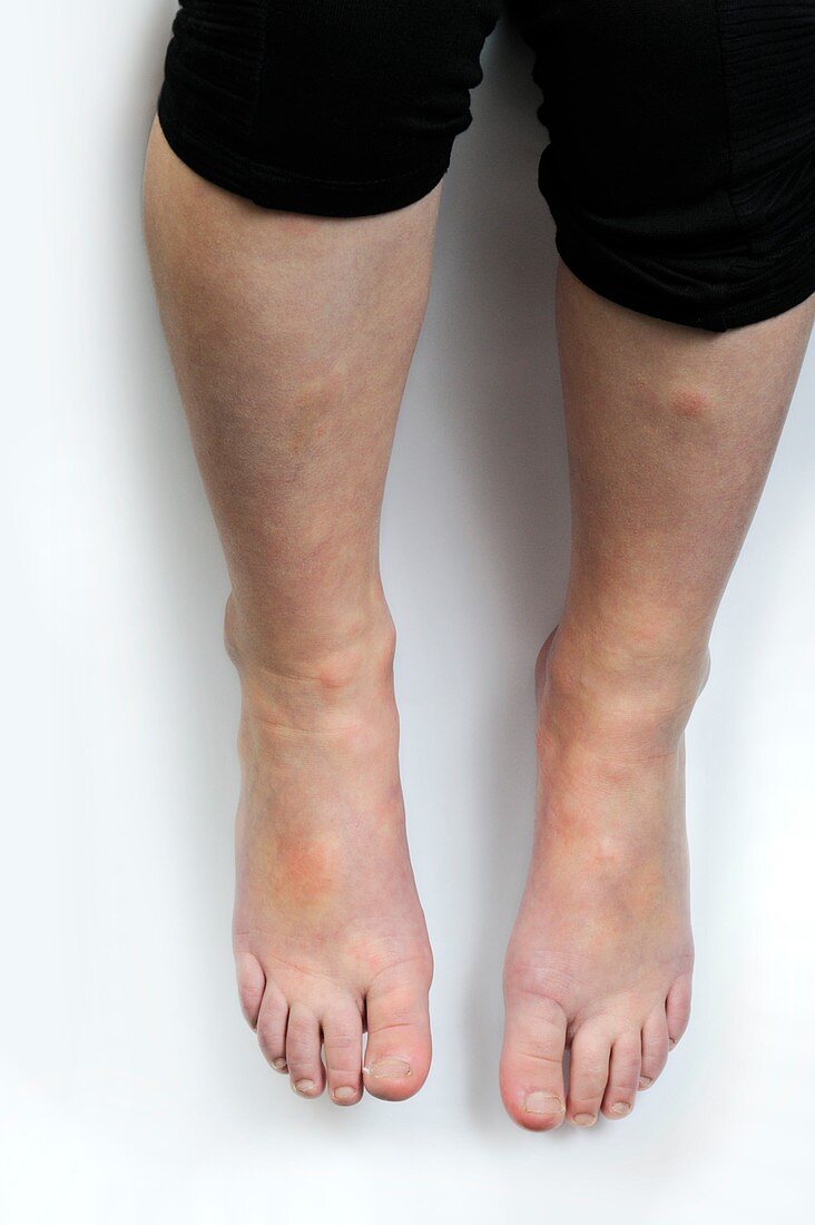 Urticaria on the legs
