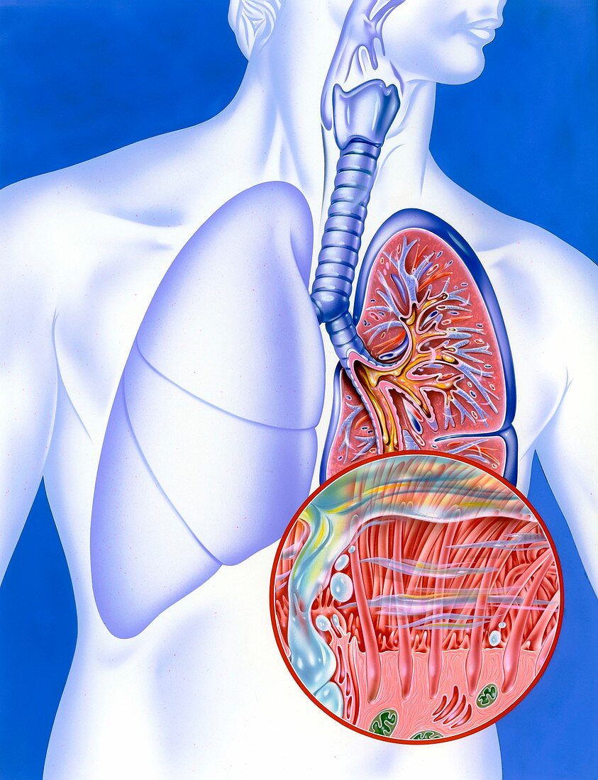 Lower respiratory tract infection