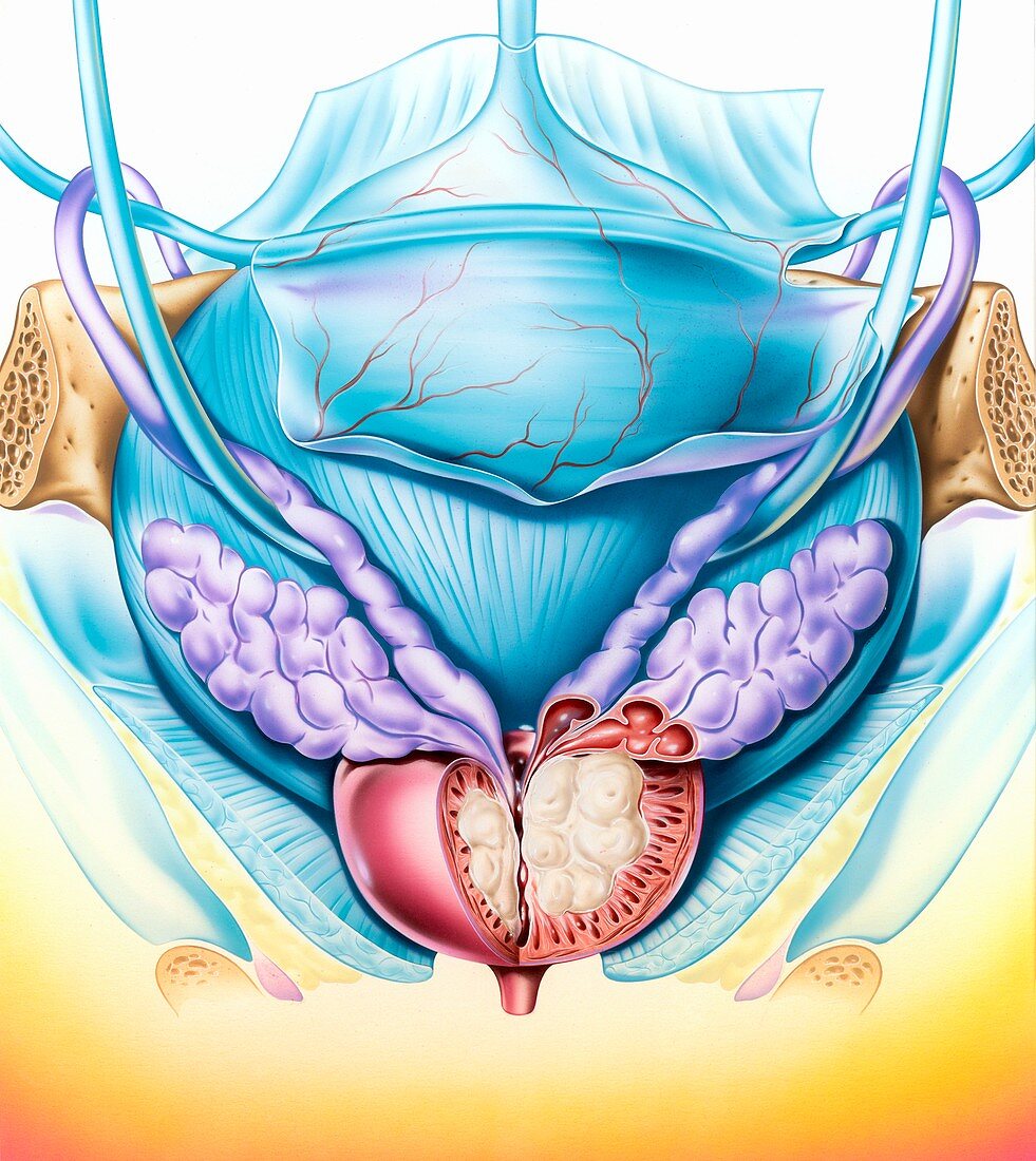 Benign prostatatic hyperplasia,artwork