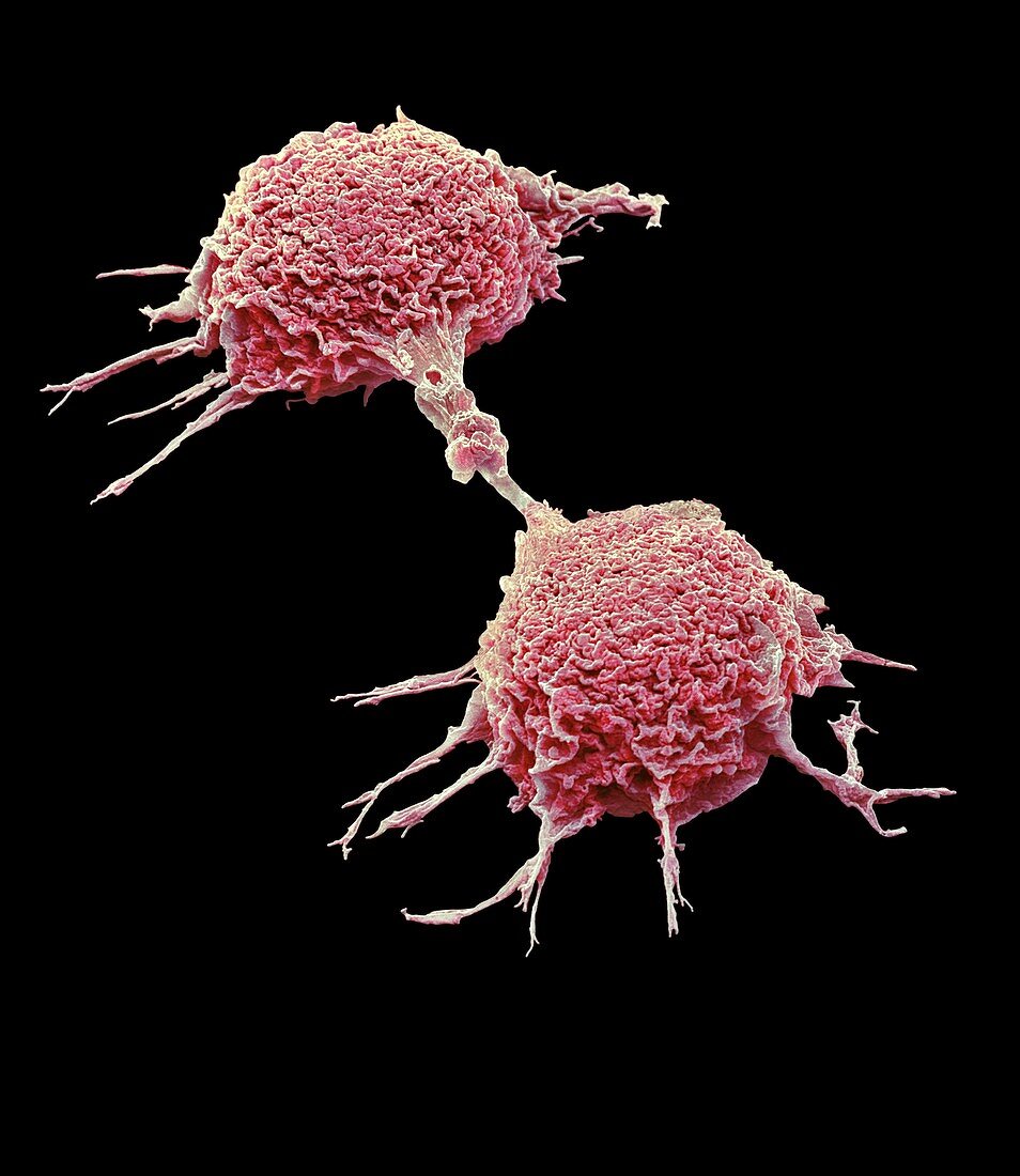 Dividing lung cancer cells,SEM