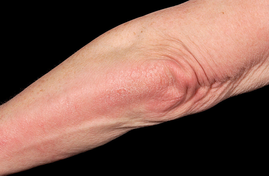 Psoriatic arthritis