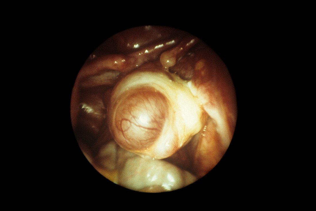 Ovulating ovary,laparoscopic image