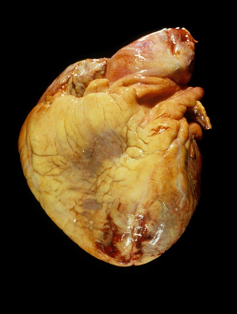 Human heart after heart attack