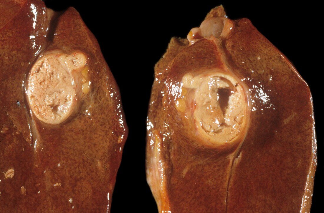 Liver tumour