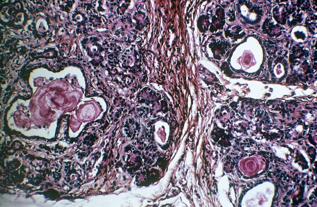 Pancreas in cystic fibrosis,micrograph