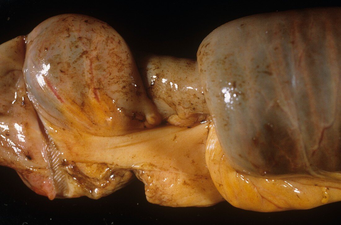 Intussusception of the intestines