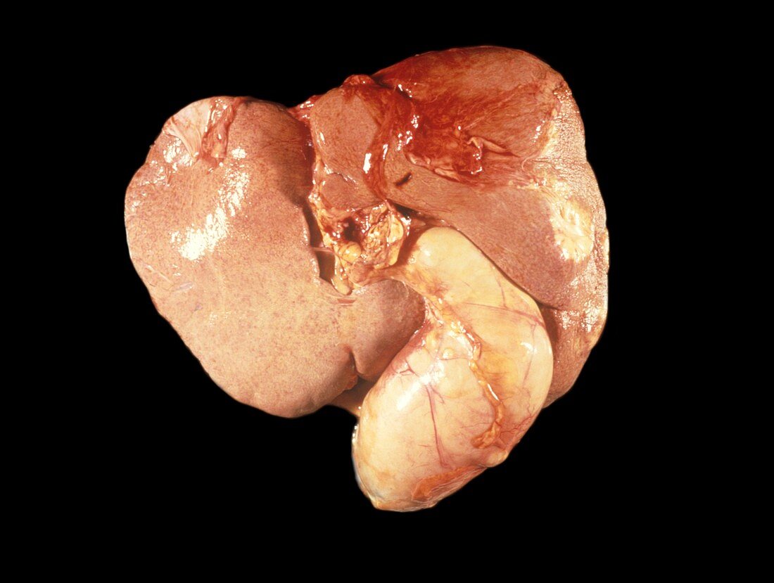 Inflamed gallbladder