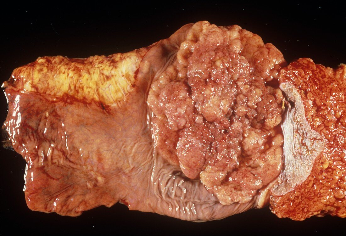 Intestinal tumour